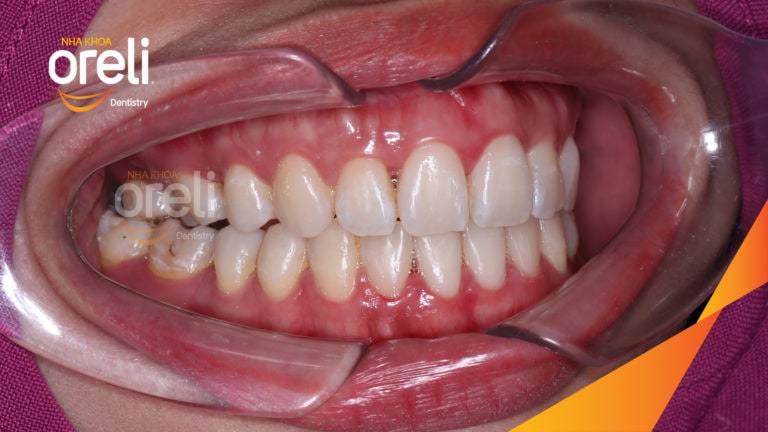 Niềng chỉnh hô và di gần răng 7 8 thay thế răng 6 kết quả thực tế tại Oreli