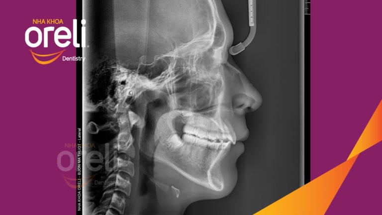 Ca niềng chỉnh hô lẹm cằm cho nụ cười đẹp kết quả thực tế sau 2,5 năm tại nha khoa Oreli