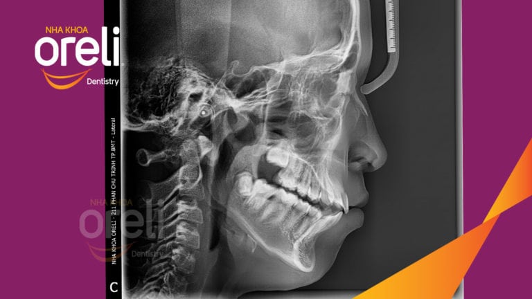 Ca niềng chỉnh hô lẹm cằm cho nụ cười đẹp kết quả thực tế sau 2,5 năm tại nha khoa Oreli