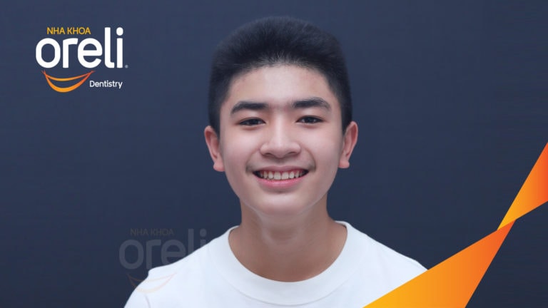 Ca niềng chỉnh hô lẹm cằm cho nụ cười đẹp kết quả thực tế sau 2,5 năm tại nha khoa Oreli
