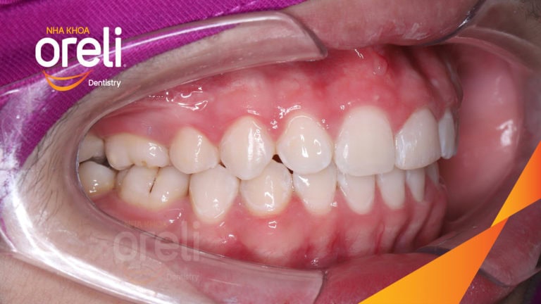 Ca niềng chỉnh hô lẹm cằm cho nụ cười đẹp kết quả thực tế sau 2,5 năm tại nha khoa Oreli