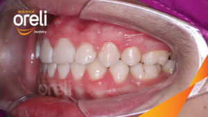 nieng rang ho cho nu cuoi dep o buon ma thuot nha khoa oreli