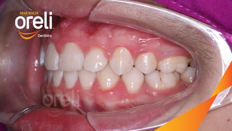 nieng rang ho cho nu cuoi dep o buon ma thuot nha khoa oreli