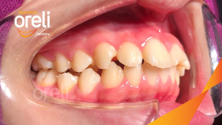 Ca niềng chỉnh hô lẹm cằm cho nụ cười đẹp kết quả thực tế sau 2,5 năm tại nha khoa Oreli