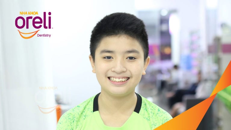 Ca niềng chỉnh hô lẹm cằm cho nụ cười đẹp kết quả thực tế sau 2,5 năm tại nha khoa Oreli