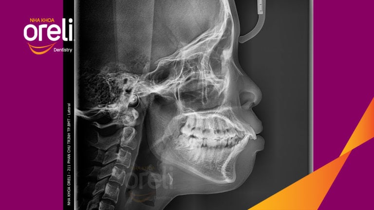 Chỉnh hô bằng niềng răng – cải thiện góc nghiêng và khớp cắn tại Oreli