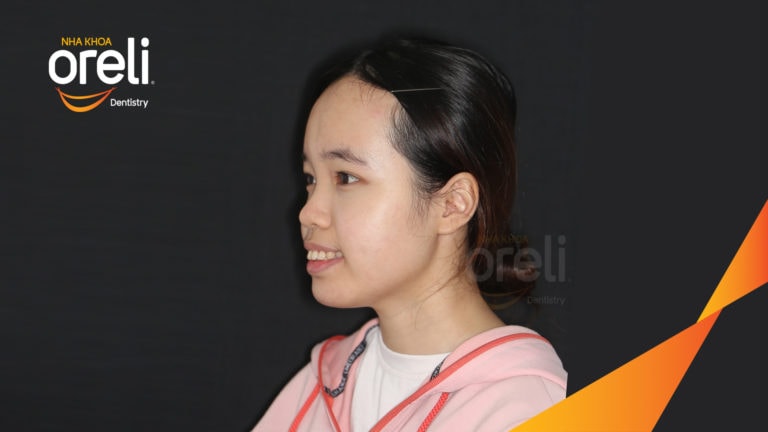 nieng rang ho thay doi goc nghieng dep nha khoa oreli