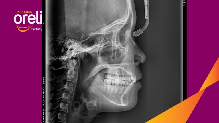 Chỉnh hô bằng niềng răng – cải thiện góc nghiêng và khớp cắn tại Oreli