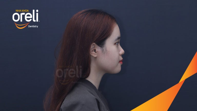 Chỉnh hô bằng niềng răng – cải thiện góc nghiêng và khớp cắn tại Oreli