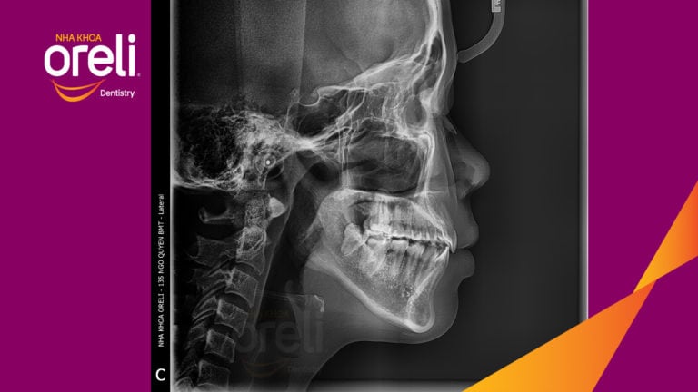 Ca niềng chỉnh hô cho nụ cười và góc ngiêng đẹp kết quả sau 3 năm tại Oreli