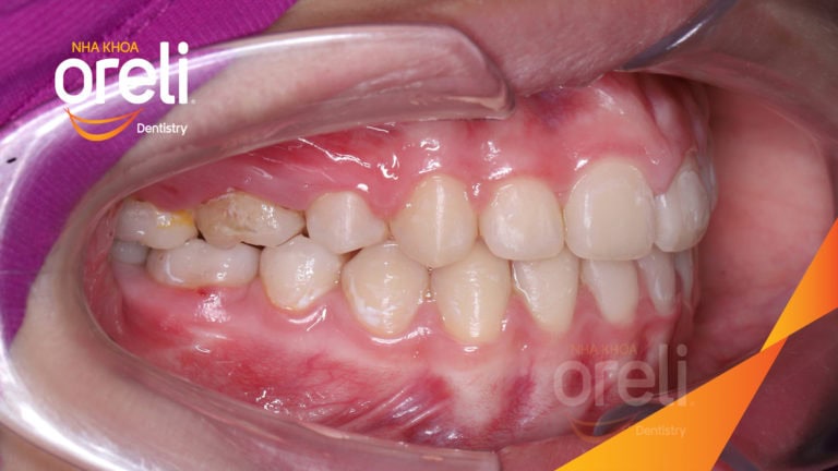 Ca niềng chỉnh hô cho nụ cười và góc ngiêng đẹp kết quả sau 3 năm tại Oreli