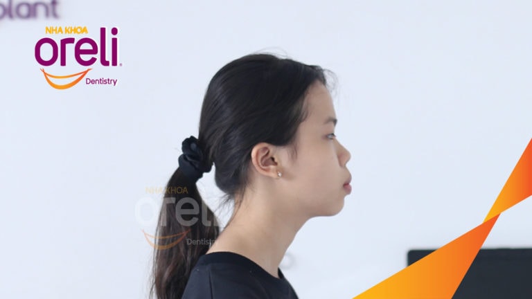 Ca niềng chỉnh hô cho nụ cười và góc ngiêng đẹp kết quả sau 3 năm tại Oreli