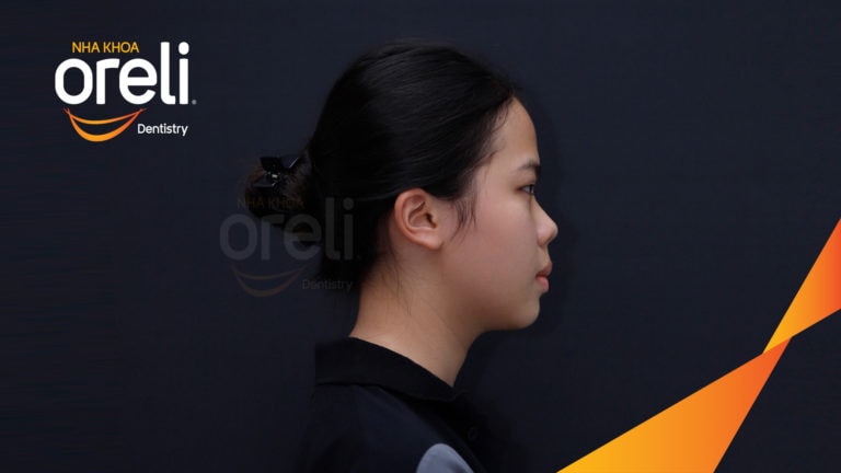 Ca niềng chỉnh hô cho nụ cười và góc ngiêng đẹp kết quả sau 3 năm tại Oreli