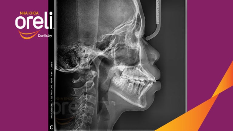Ca niềng chỉnh hô cho nụ cười và góc ngiêng đẹp kết quả sau 3 năm tại Oreli