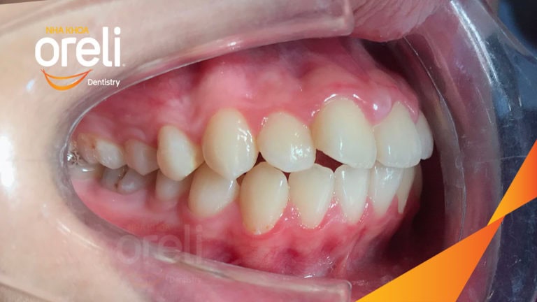 Ca niềng chỉnh hô cho nụ cười và góc ngiêng đẹp kết quả sau 3 năm tại Oreli