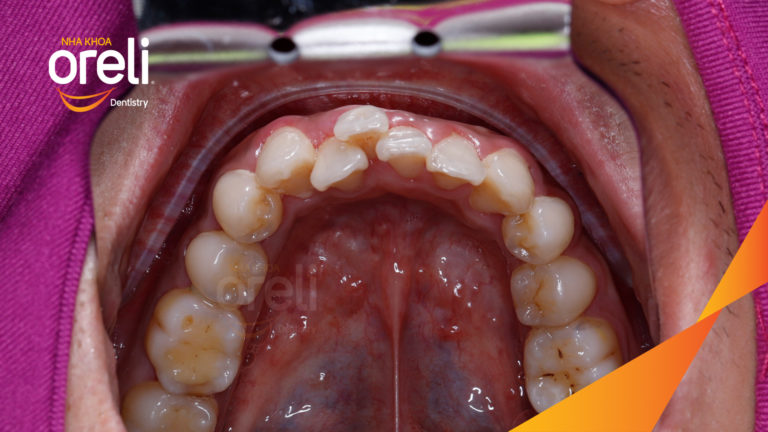 Niềng chỉnh một hàm dưới cho nụ cười đẹp đúng khớp cắn