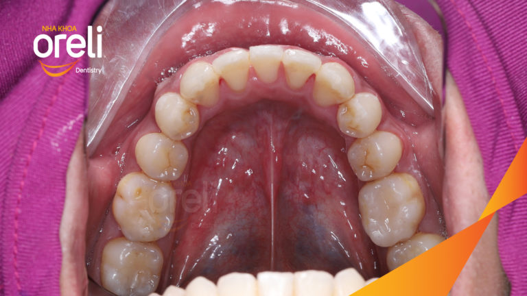 Niềng chỉnh một hàm dưới cho nụ cười đẹp đúng khớp cắn