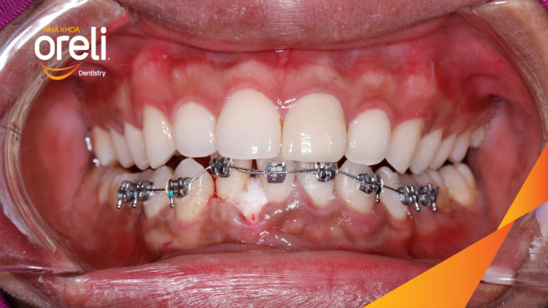 Niềng chỉnh một hàm dưới cho nụ cười đẹp đúng khớp cắn