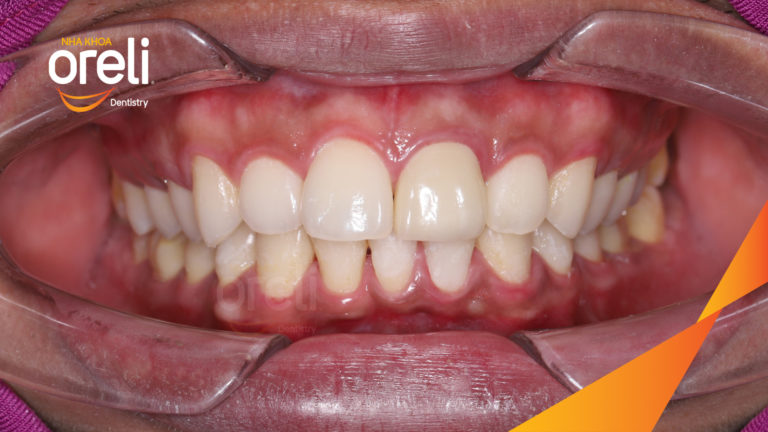 Niềng chỉnh một hàm dưới cho nụ cười đẹp đúng khớp cắn