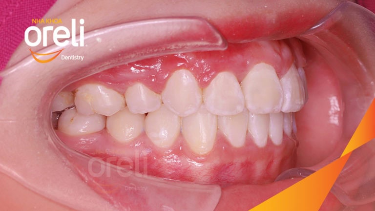 Ca niềng chỉnh hô tiếp tục cho ca đang niềng dở kết thúc đẹp ở Oreli