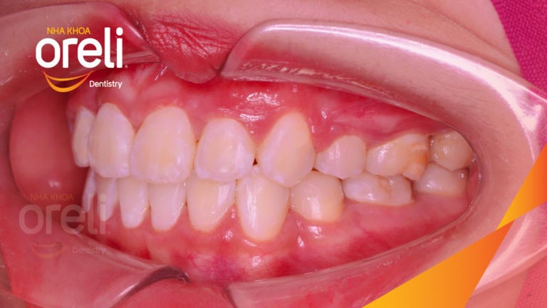 Ca niềng chỉnh hô tiếp tục cho ca đang niềng dở kết thúc đẹp ở Oreli