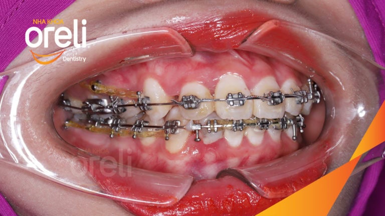 Ca niềng chỉnh hô tiếp tục cho ca đang niềng dở kết thúc đẹp ở Oreli