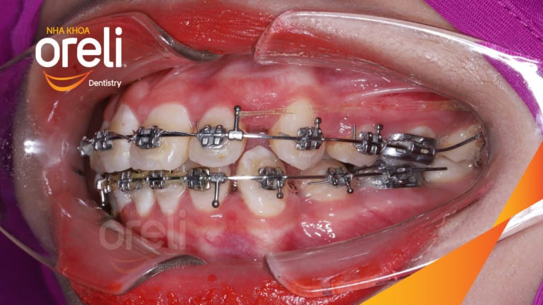 Ca niềng chỉnh hô tiếp tục cho ca đang niềng dở kết thúc đẹp ở Oreli