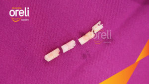 Ghép xương Carotta