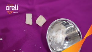 Ghép xương Khoury