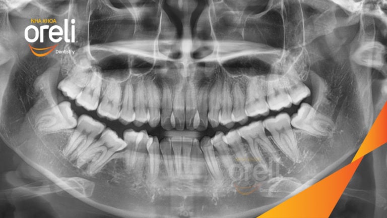 Ca niềng chỉnh hô chen chúc bằng mắc cài kết quả thực tế tại nha khoa Oreli