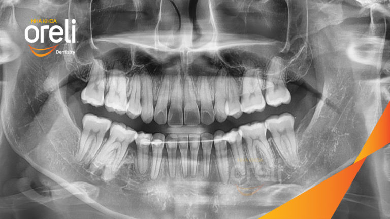 Ca niềng chỉnh hô chen chúc bằng mắc cài kết quả thực tế tại nha khoa Oreli