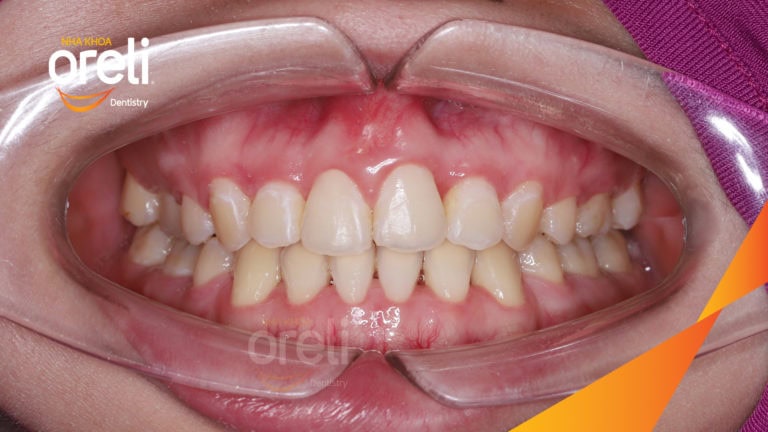 Ca niềng chỉnh hô chen chúc bằng mắc cài kết quả thực tế tại nha khoa Oreli