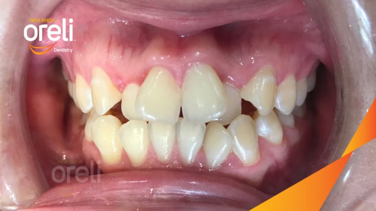 Ca niềng chỉnh hô chen chúc bằng mắc cài kết quả thực tế tại nha khoa Oreli
