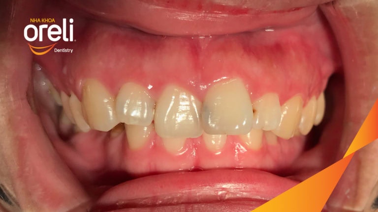 Ca niềng chỉnh hô cắn sâu cười hở nướu kết quả thực tế tại Oreli