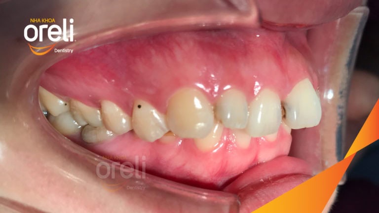 Ca niềng chỉnh hô cắn sâu cười hở nướu kết quả thực tế tại Oreli