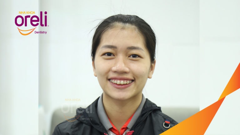Ca niềng chỉnh hô cắn sâu cười hở nướu kết quả thực tế tại Oreli