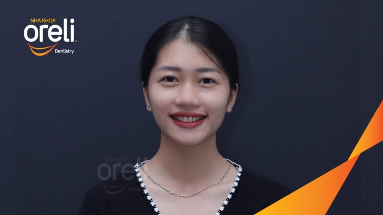 Ca niềng chỉnh hô cắn sâu cười hở nướu kết quả thực tế tại Oreli
