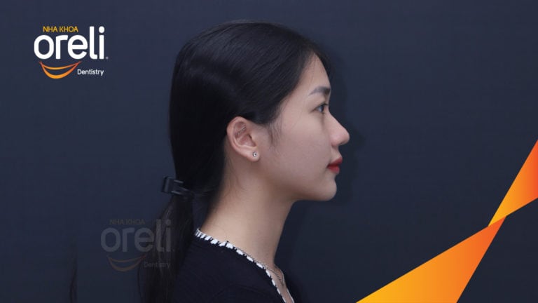 Ca niềng chỉnh hô cắn sâu cười hở nướu kết quả thực tế tại Oreli