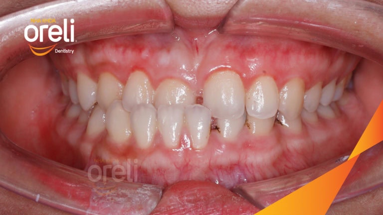 Ca niềng chỉnh cắn ngược răng cửa kết quả sau 18 tháng ở nha khoa Oreli
