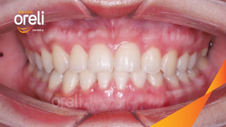 Ca niềng chỉnh cắn ngược răng cửa kết quả sau 18 tháng ở nha khoa Oreli
