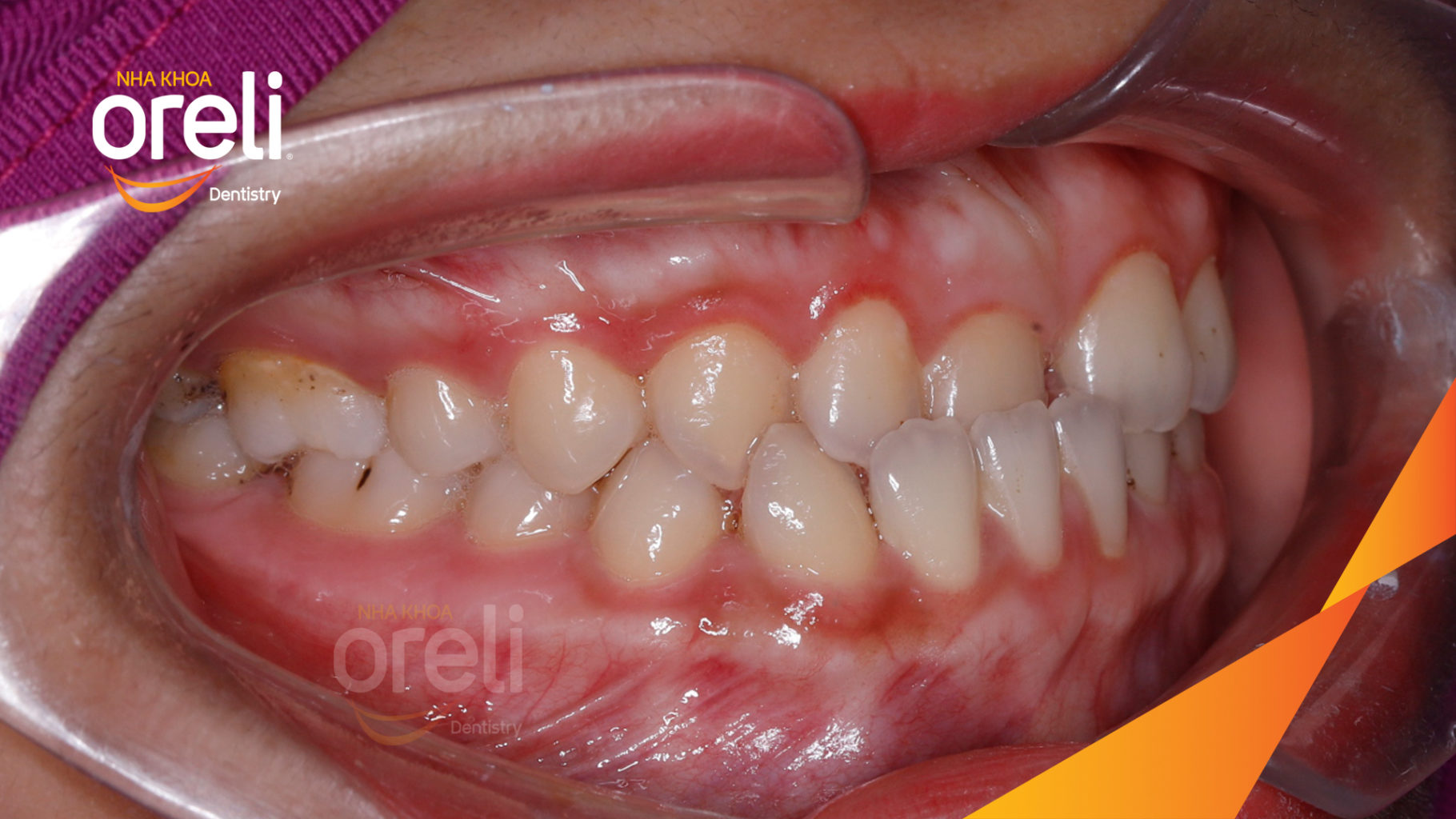 Trước điều trị: Cắn ngược răng cửa sai khớp cắn hạng 3 tại Nha khoa Oreli