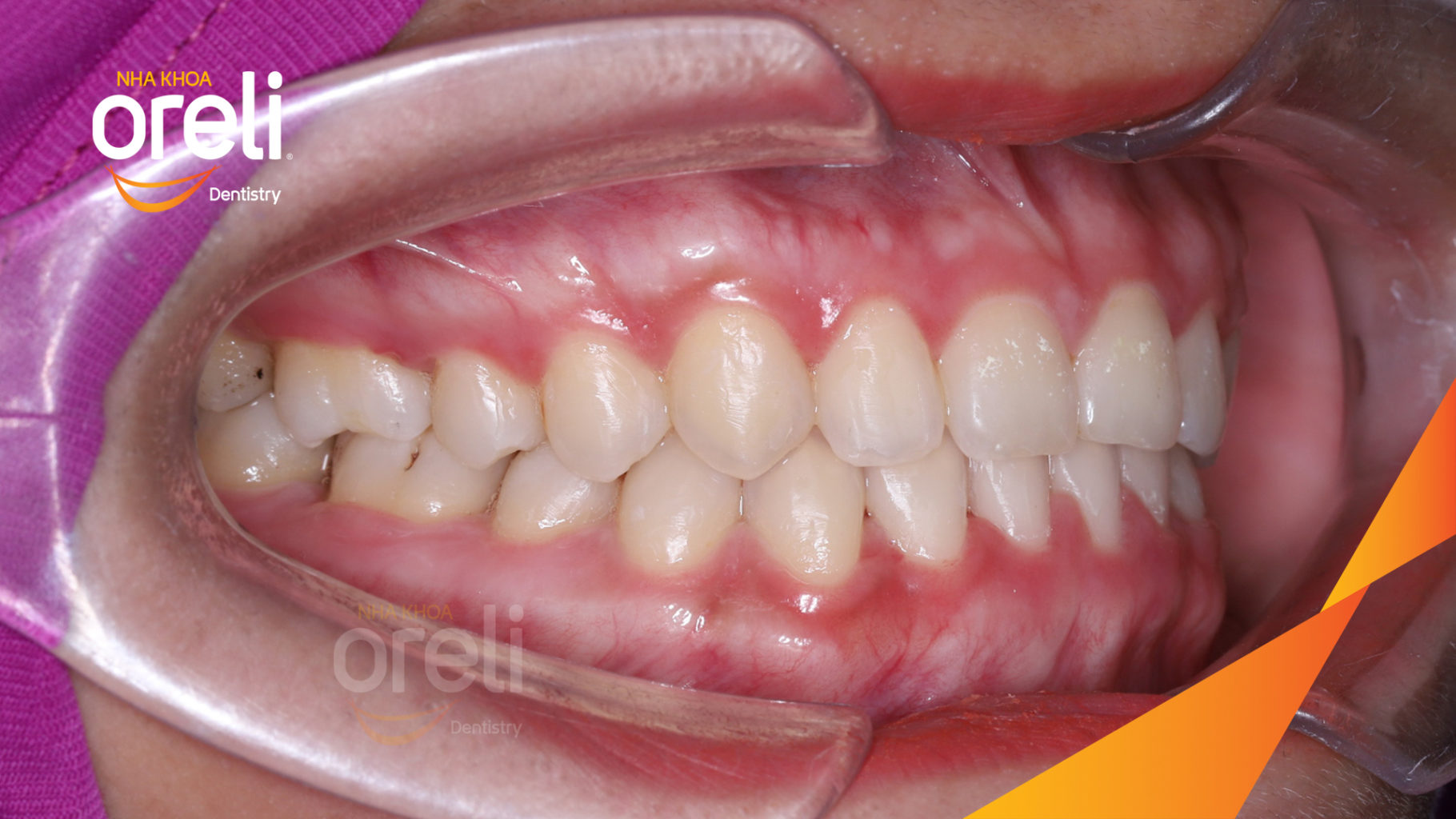 Cắn ngược răng cửa sai khớp cắn hạng 3 trước khi điều trị tại Nha khoa Oreli