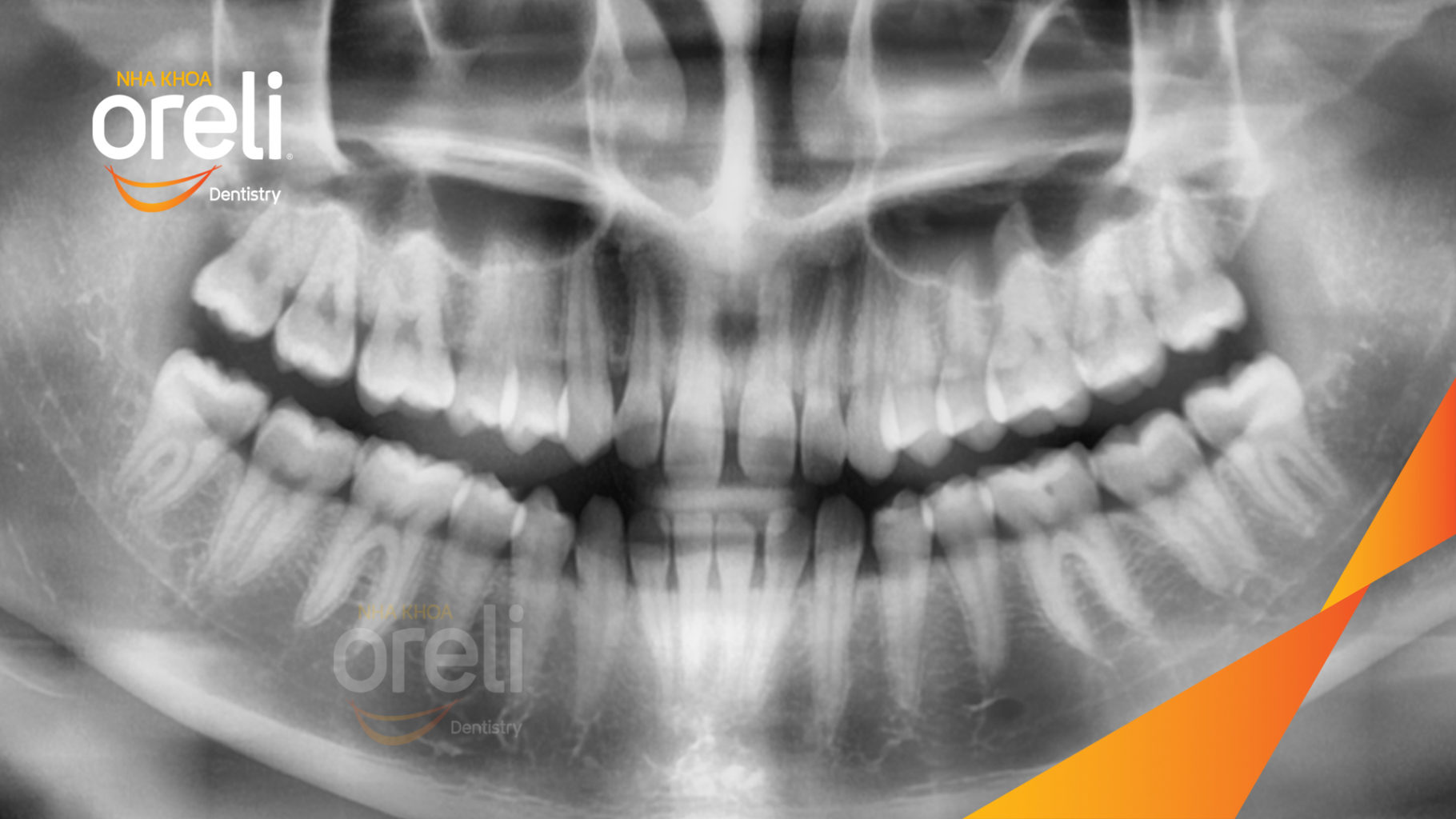 Trước điều trị: Cắn ngược răng cửa sai khớp cắn hạng 3 tại Nha khoa Oreli
