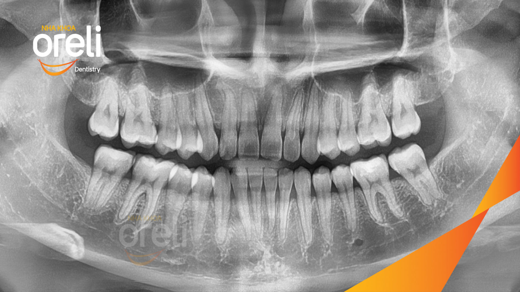 Cắn ngược răng cửa sai khớp cắn hạng 3 trước khi điều trị tại Nha khoa Oreli