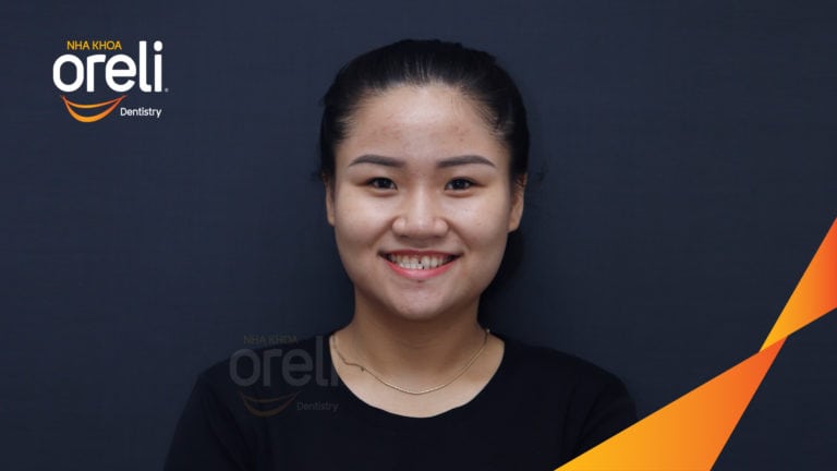 Ca niềng chỉnh cắn ngược răng cửa kết quả sau 18 tháng ở nha khoa Oreli