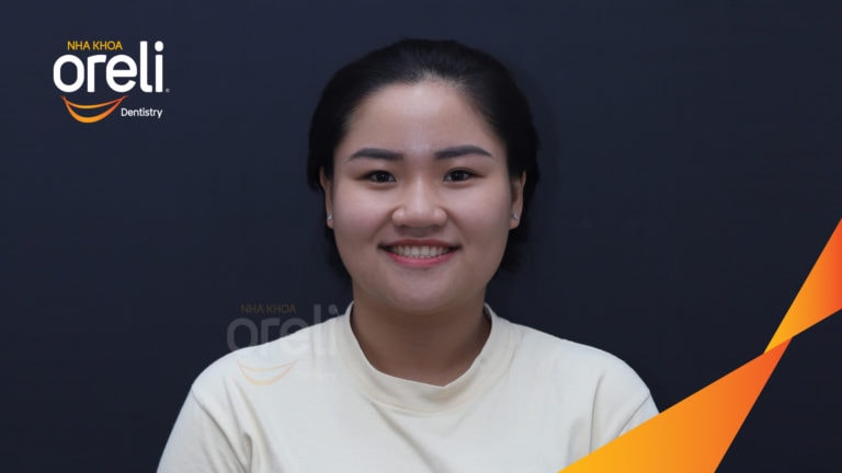 Ca niềng chỉnh cắn ngược răng cửa kết quả sau 18 tháng ở nha khoa Oreli