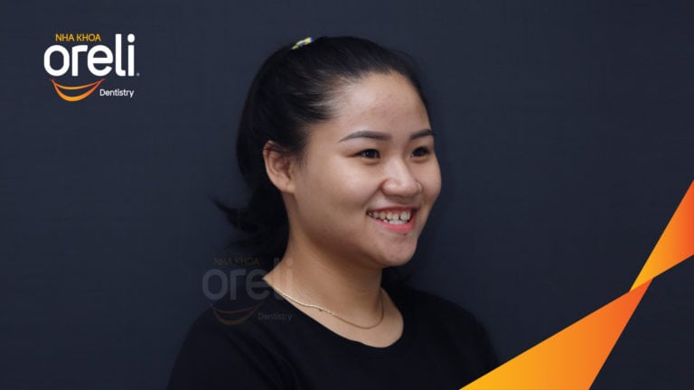 Ca niềng chỉnh cắn ngược răng cửa kết quả sau 18 tháng ở nha khoa Oreli