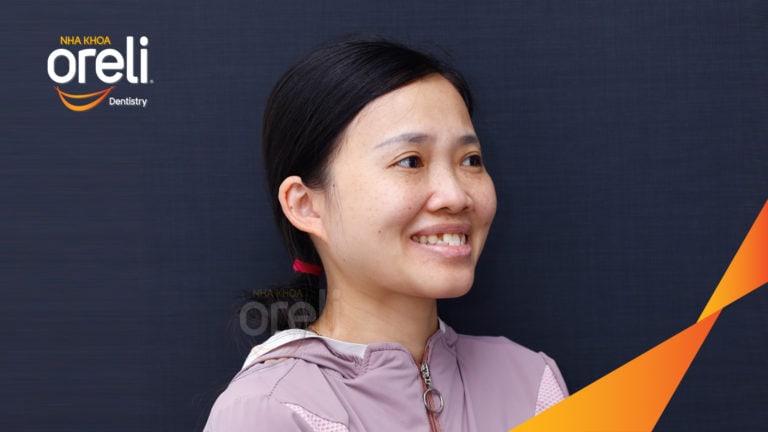 Ca niềng chỉnh sai khớp cắn hạng 3 móm nặng kèm chen chúc kết quả thực tế sau 3 năm