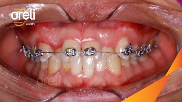 Ca niềng chỉnh sai khớp cắn hạng 3 móm nặng kèm chen chúc kết quả thực tế sau 3 năm