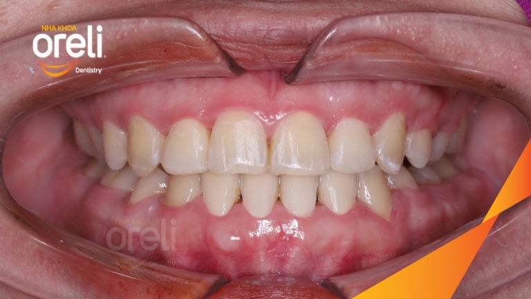 Ca niềng chỉnh sai khớp cắn hạng 3 móm nặng kèm chen chúc kết quả thực tế sau 3 năm